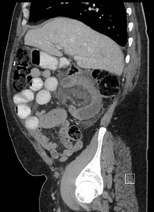 Closed loop obstruction - internal hernia into nephrectomy bed (Radiopaedia 59867-67320 C 73).jpg