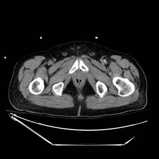 File:Closed loop obstruction due to adhesive band, resulting in small bowel ischemia and resection (Radiopaedia 83835-99023 Axial non-contrast 161).jpg