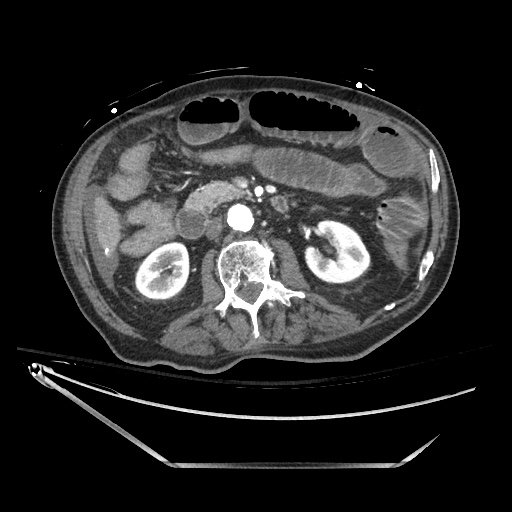 Closed loop obstruction due to adhesive band, resulting in small bowel ischemia and resection (Radiopaedia 83835-99023 B 65).jpg