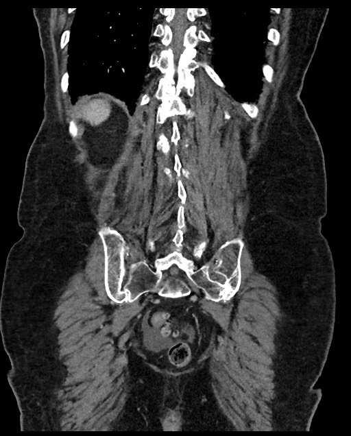 Closed loop small bowel obstruction - adhesions (Radiopaedia 59269-66611 B 103).jpg