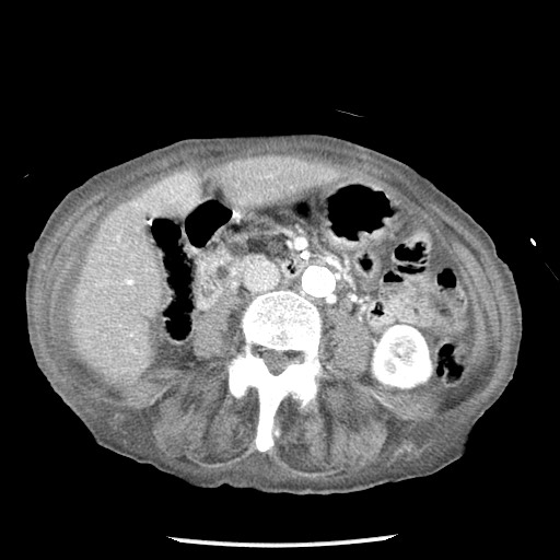 Closed loop small bowel obstruction - adhesions and infarct (Radiopaedia 85125-100678 B 48).jpg