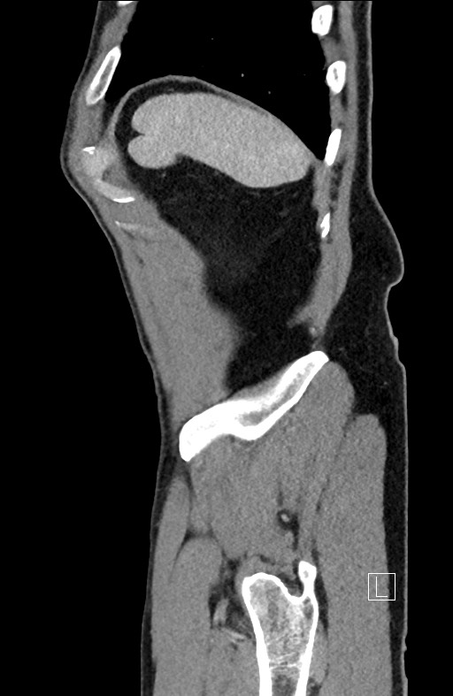 Closed loop small bowel obstruction - internal hernia (Radiopaedia 57806-64778 C 18).jpg