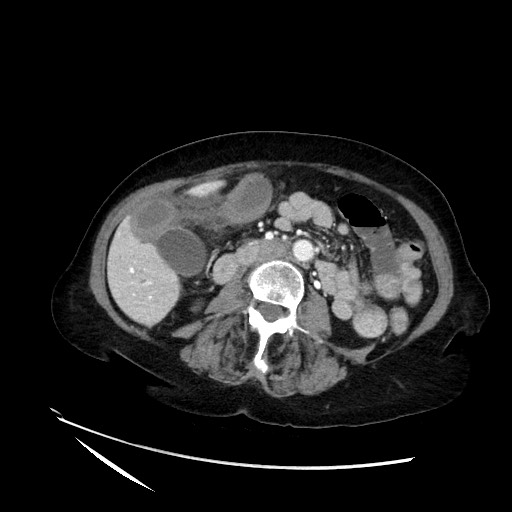File:Closed loop small bowel obstruction due to adhesive band, with intramural hemorrhage and ischemia (Radiopaedia 83831-99017 Axial 19).jpg