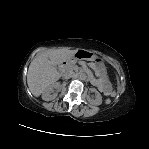 Closed loop small bowel obstruction due to adhesive band, with intramural hemorrhage and ischemia (Radiopaedia 83831-99017 Axial non-contrast 64).jpg