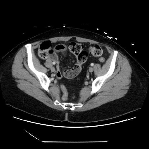 Closed loop small bowel obstruction due to adhesive bands - early and late images (Radiopaedia 83830-99014 A 121).jpg