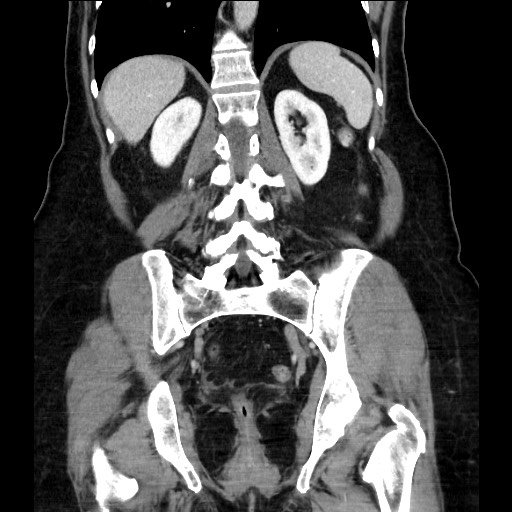 Closed loop small bowel obstruction due to adhesive bands - early and late images (Radiopaedia 83830-99014 B 89).jpg