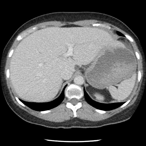 File:Closed loop small bowel obstruction due to trans-omental herniation (Radiopaedia 35593-37109 A 23).jpg