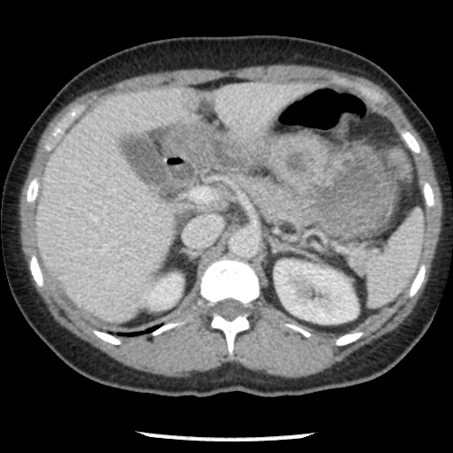 File:Closed loop small bowel obstruction due to trans-omental herniation (Radiopaedia 35593-37109 A 28).jpg