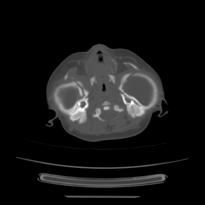 Cloverleaf skull (Radiopaedia 91901-109710 Axial bone window 41).jpg