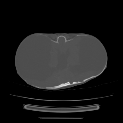 Cloverleaf skull (Radiopaedia 91901-109710 Axial bone window 86).jpg