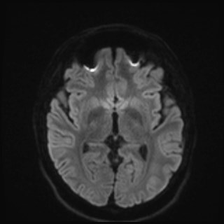 File:Cochlear incomplete partition type III associated with hypothalamic hamartoma (Radiopaedia 88756-105498 Axial DWI 60).jpg