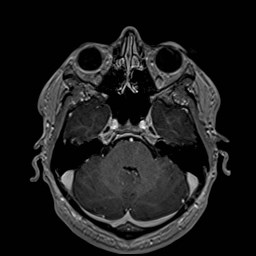 File:Cochlear incomplete partition type III associated with hypothalamic hamartoma (Radiopaedia 88756-105498 Axial T1 C+ 64).jpg