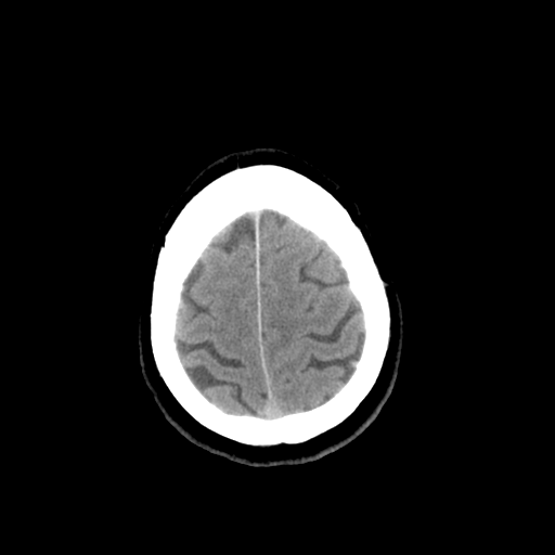 File:Colloid cyst (large) (Radiopaedia 34415-35734 Axial non-contrast 50).png