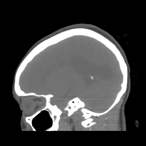 File:Colloid cyst (resulting in death) (Radiopaedia 33423-34499 B 38).png