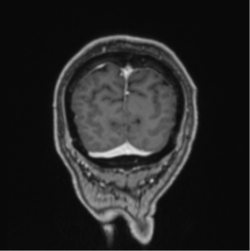 File:Colloid cyst of the third ventricle (Radiopaedia 86571-102662 Coronal T1 C+ 13).png