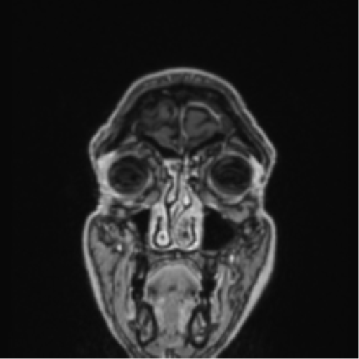 Colloid cyst of the third ventricle (Radiopaedia 86571-102662 Coronal T1 C+ 84).png