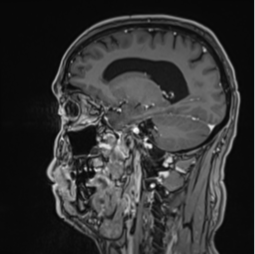 File:Colloid cyst of the third ventricle (Radiopaedia 86571-102662 Sagittal T1 C+ 28).png
