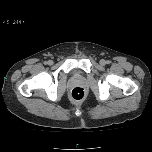 File:Colo-cutaneous fistula (Radiopaedia 40531-43129 A 102).jpg