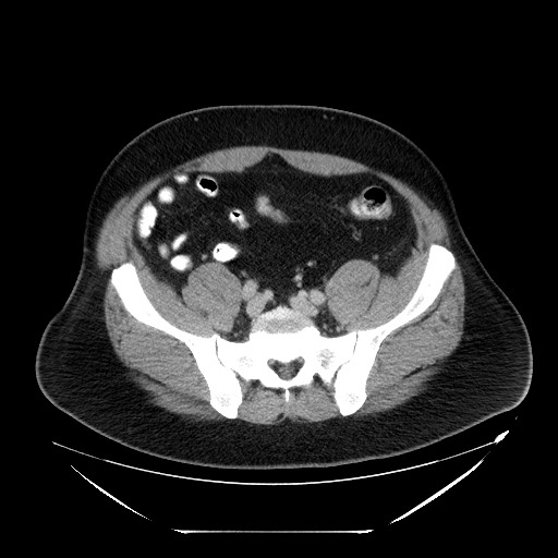 File:Colocolic intussusception due to lipoma (Radiopaedia 73712-84508 Axial 87).jpg