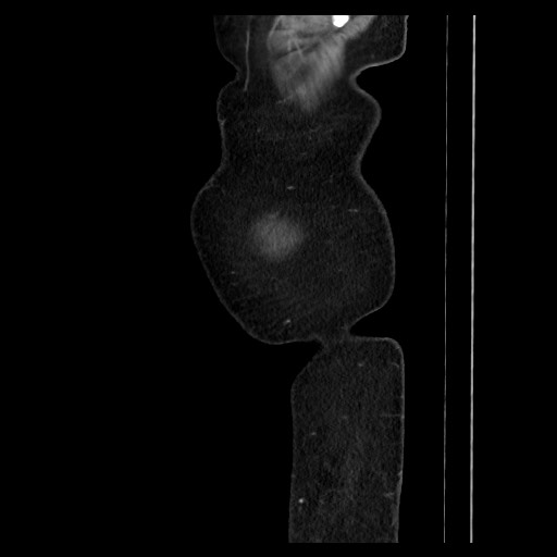 Colocolic intussusception due to tubular adenoma (Radiopaedia 73744-84551 C 17).jpg