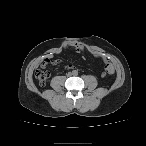 File:Colocutaneous fistula in Crohn's disease (Radiopaedia 29586-30093 Axial non-contrast 13).jpg
