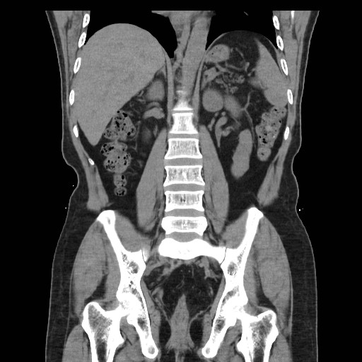 File:Colocutaneous fistula in Crohn's disease (Radiopaedia 29586-30093 Coronal non-contrast 25).jpg