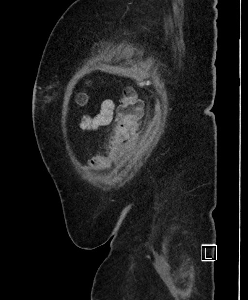 Colon adenocarcinoma (Radiopaedia 59374-66735 C 10).jpg