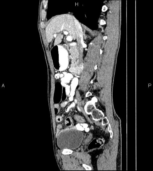 Colon adenocarcinoma - hepatic flexure (Radiopaedia 85635-101395 D 35).jpg