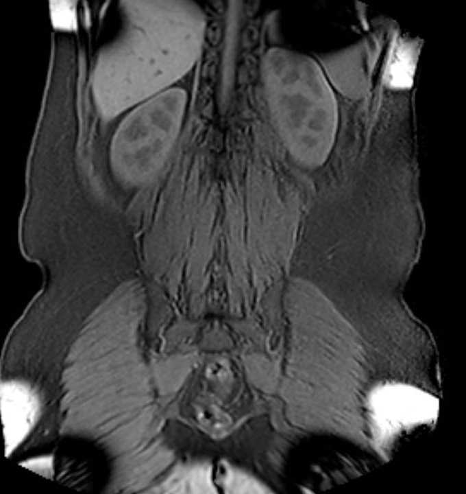Colon adenocarcinoma with Krukenberg tumors, advanced pregnancy (Radiopaedia 67279-76645 E 77).jpg