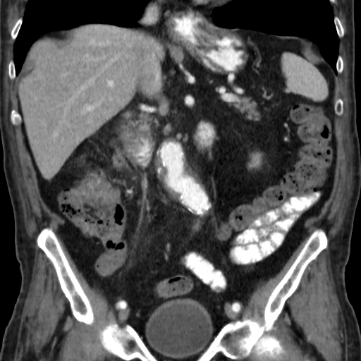 File:Colon cancer with duodenal invasion (Radiopaedia 16278-15958 B 31).jpg