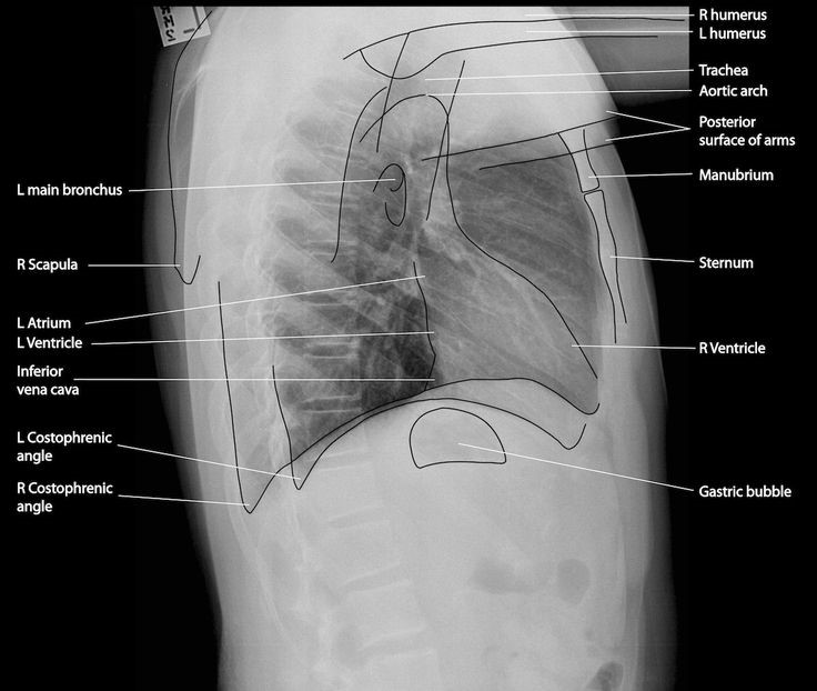 Figure 5.6B Line Drawing of Lateral Chest x-ray.jpg