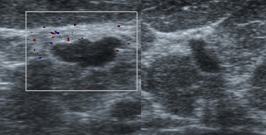 File:Infiltrating ductal breast carcinoma on ultrasound (Radiopaedia 19712).png
