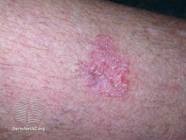 File:Intraepidermal carcinoma (DermNet NZ lesions-scc-in-situ-2911).jpg