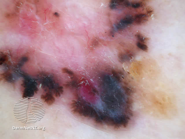 File:Leaf-like structures in pigmented basal cell carcinoma dermoscopy (DermNet NZ doctors-dermoscopy-course-images-bcc56).jpg