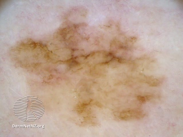 File:Melanoma in situ, polarised dermoscopy view (DermNet NZ 20130417111828764).jpg