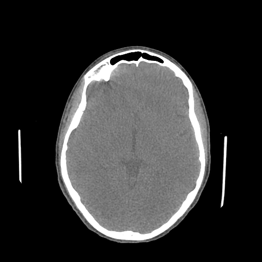 File:Nasal pyogenic granuloma (lobular capillary hemangioma) (Radiopaedia 85536-101244 Axial non-contrast 130).jpg