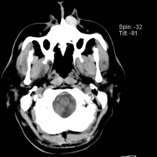 File:Nasolabial cyst (Radiopaedia 28401-28650 Axial non-contrast 1).jpg