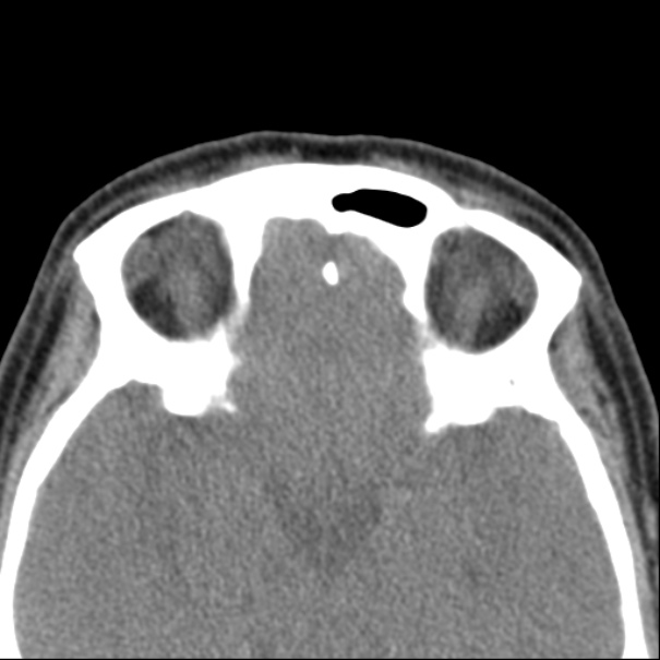 Nasolabial cyst (Radiopaedia 33987-35205 Axial non-contrast 43).jpg