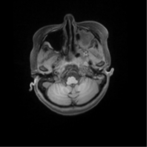 File:Nasopharyngeal carcinoma with cerebral abscess (Radiopaedia 43018-46274 Axial T1 fat sat 12).png