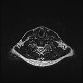 Nasopharyngeal carcinoma with perineural spread (Radiopaedia 55030-61380 Axial T2 68).jpg