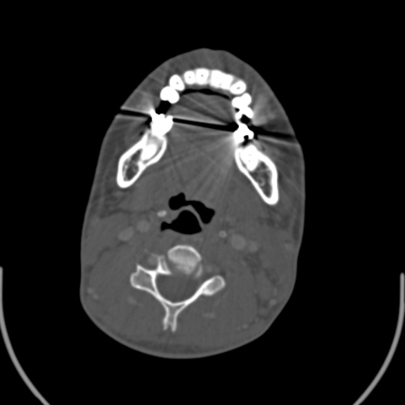 Nasopharyngeal carcinoma with skull base invasion (Radiopaedia 53415-59705 Axial bone window 114).jpg
