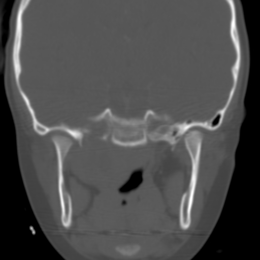 File:Nasopharyngeal rhabdomyosarcoma (Radiopaedia 23417-23491 Coronal bone window 3).jpg
