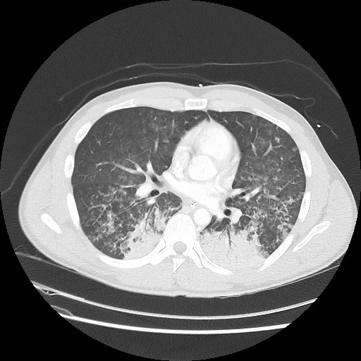 Near-drowning pulmonary edema (Radiopaedia 59457-66814 Axial lung window 31).jpg