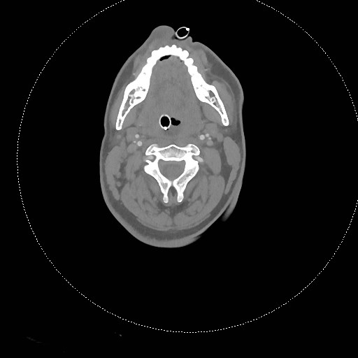 Neck CT angiogram (intraosseous vascular access) (Radiopaedia 55481-61945 B 210).jpg