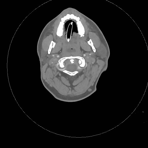 Neck CT angiogram (intraosseous vascular access) (Radiopaedia 55481-61945 B 234).jpg