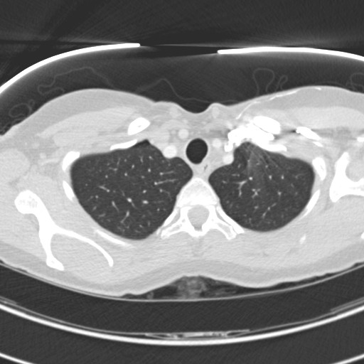 Necrobiotic pulmonary nodules - Crohn disease (Radiopaedia 20723-20631 Axial lung window 22).jpg