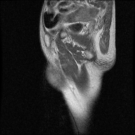 File:Necrotizing epididymo-orchitis with intra-testicular abscess (Radiopaedia 29397-29860 Sagittal T1 C+ 16).jpg