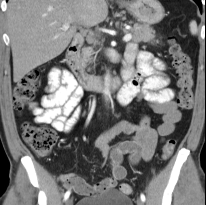 File:Necrotizing pancreatitis with acute necrotic collection (Radiopaedia 14470-14417 C 19).jpg