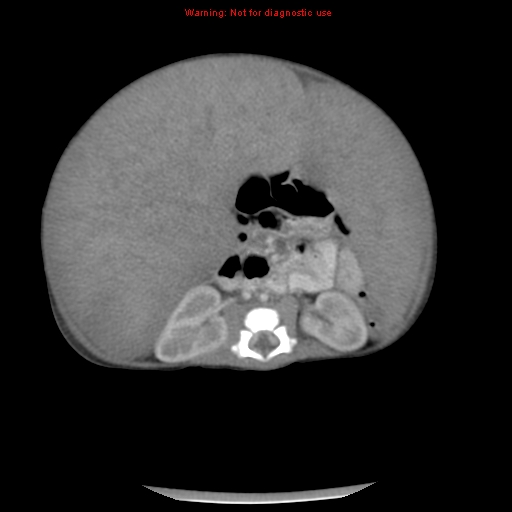 File:Neonatal neuroblastoma (Radiopaedia 9564-10223 A 30).jpg