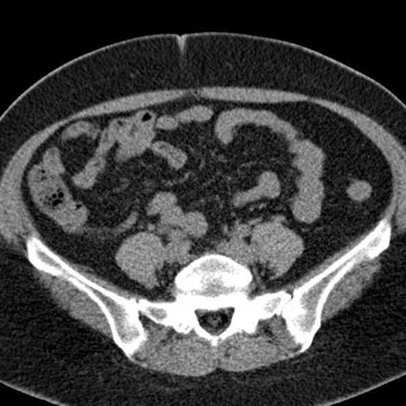 File:Nephrostomy for urosepsis (Radiopaedia 26180-26330 Axial non-contrast 43).jpg